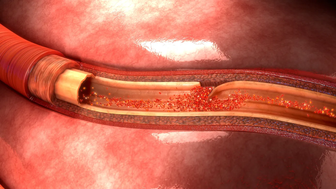 Illustration of an aortic dissection