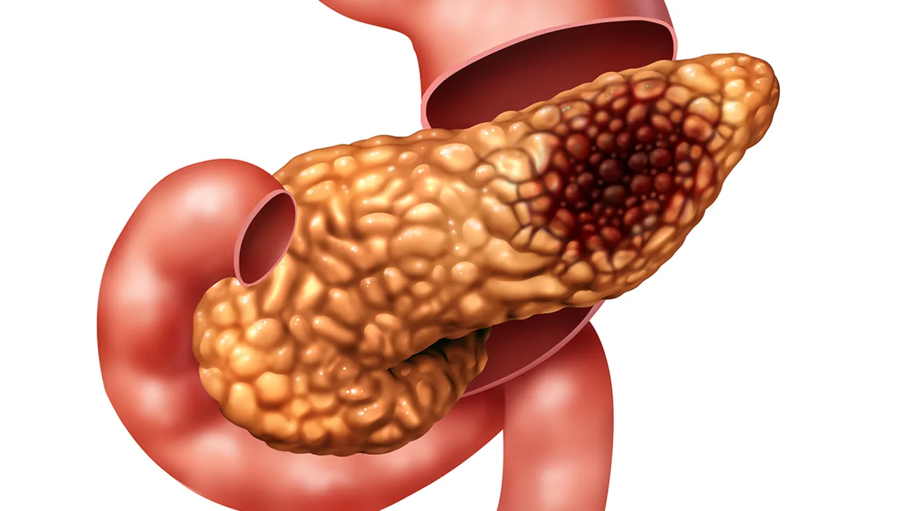 Illustration of the pancreas with tumors