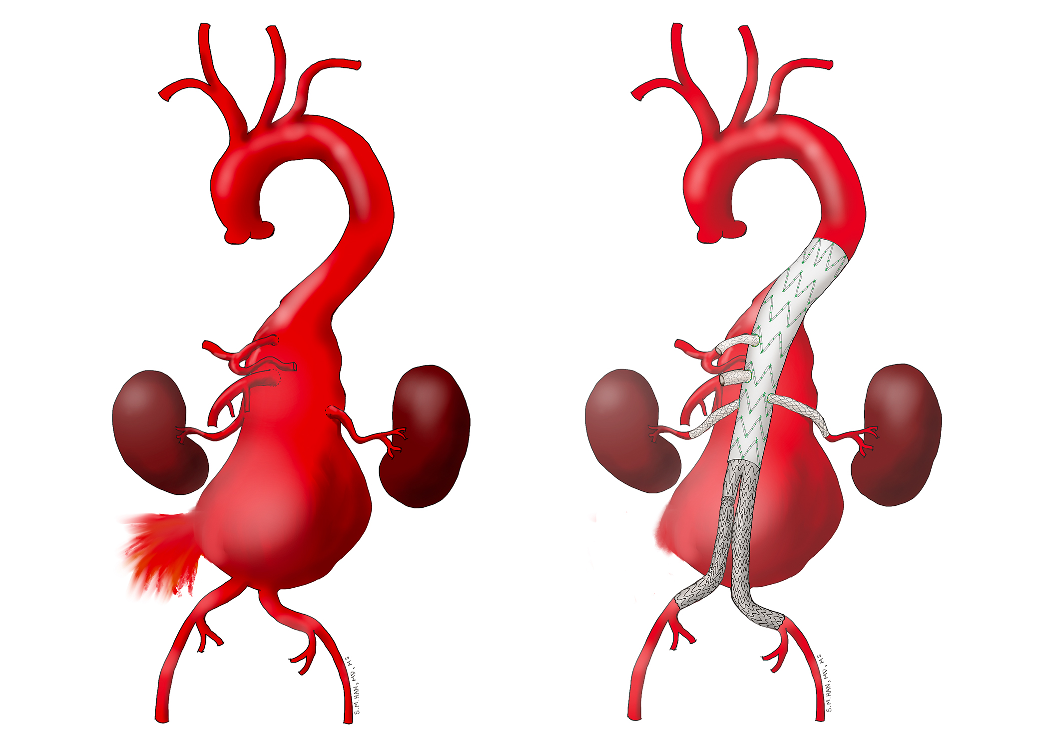 Preventing Spinal Cord Stroke Following Endovascular Thoracoabdominal ...